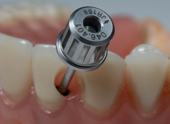 Dental Implants To Replace Missing Teeth